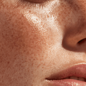 Limpieza Facial con microdermoabrasión